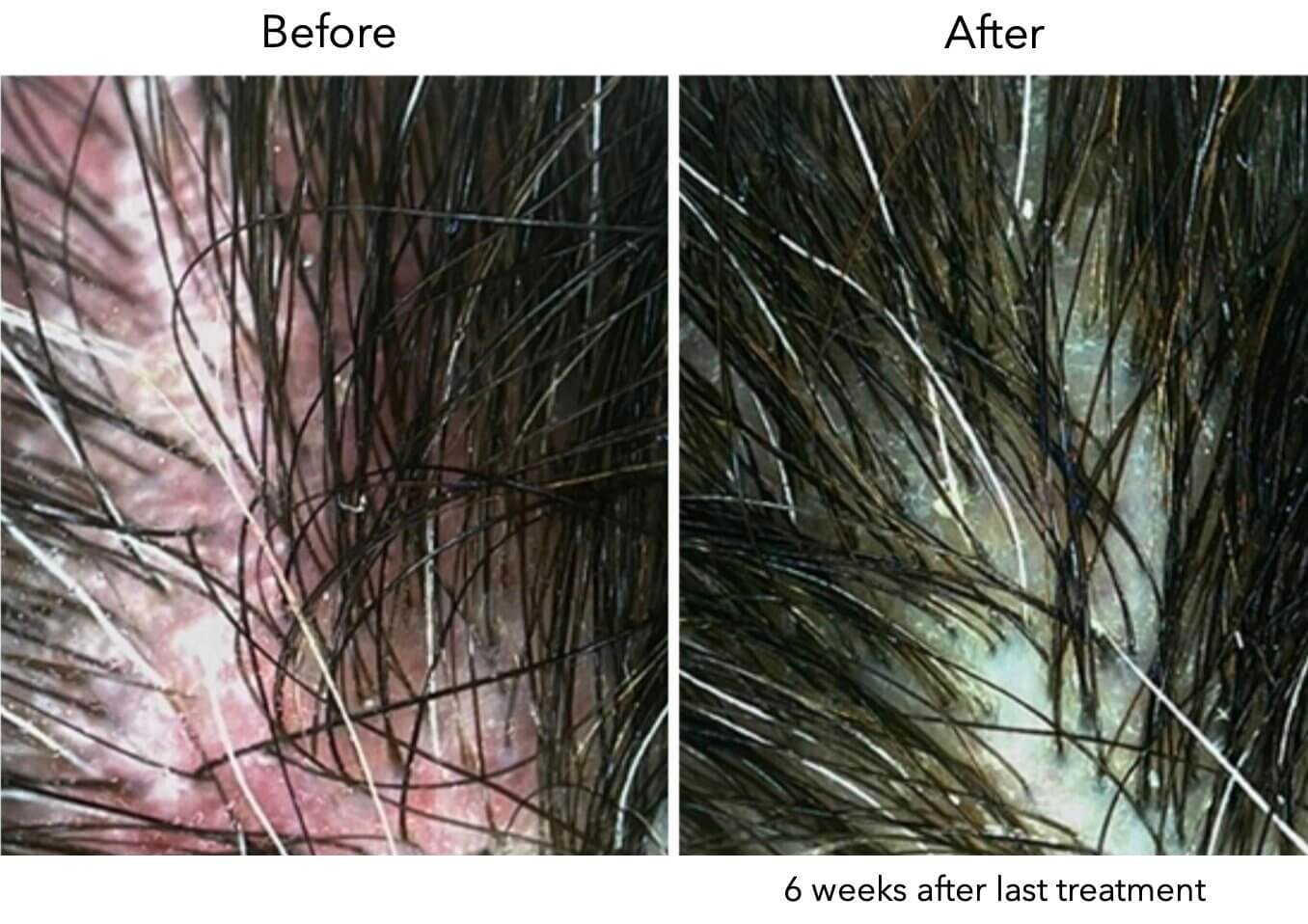 Омоложение с использованием собственных экзосом