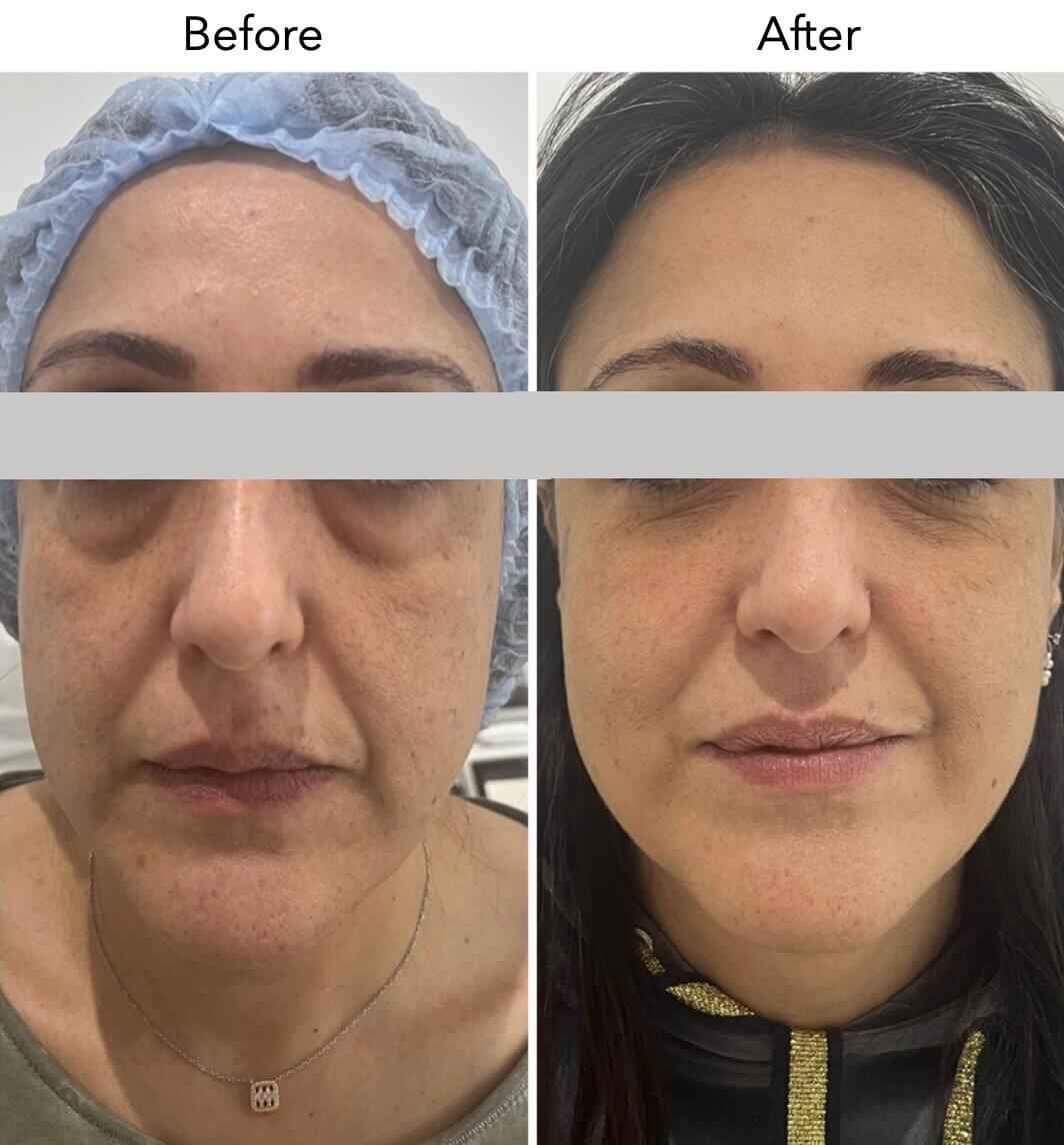 Омоложение с использованием собственных экзосом